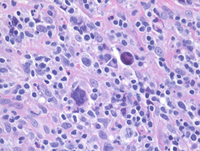 Nodular sclerosis Hodgkin lymphoma with classic Reed-Sternberg cells