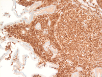 BCL2 Duodenal follicular lymphoma