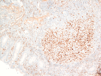 BCL6 Duodenal follicular lymphoma