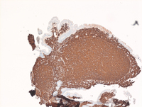 CD20Duodenal-follicular-lymphoma