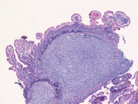 Duodenal follicular lymphoma