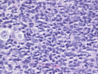 Duodenal follicular lymphoma