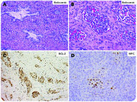 “Double-expressor” intravascular large B-cell lymphoma involving the female genital tract