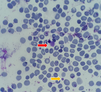 presentation of many large platelets in peripheral blood 3