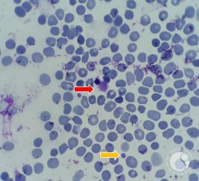 presentation of many large platelets in peripheral blood 3