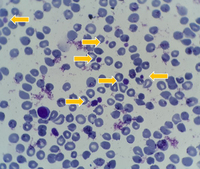 presentation of many large platelets in peripheral blood 4