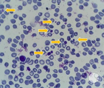 presentation of many large platelets in peripheral blood 4
