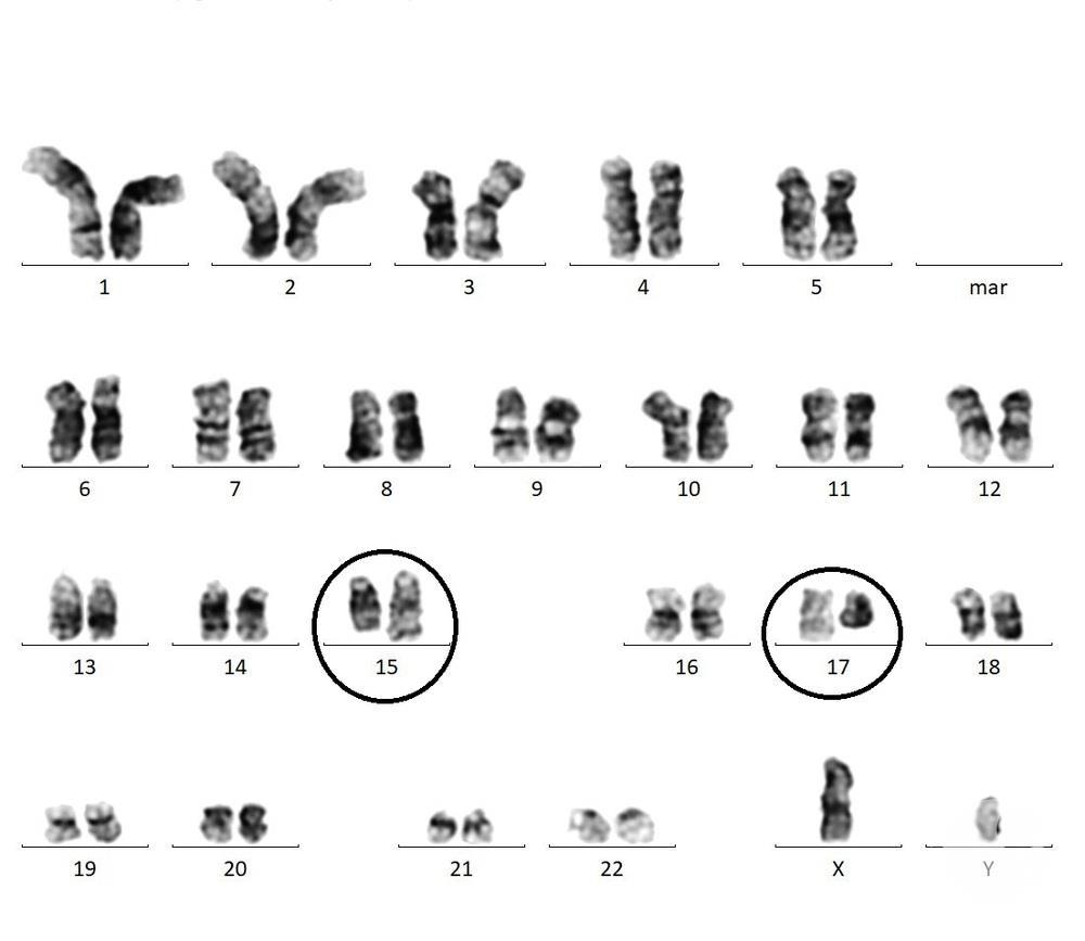 Karyotype showing classic translocation t(15;17)(q24;q21)