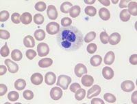 Dysplastic neutrophil in MDS with GATA2 mutation