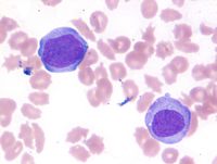 blast peripheral blood