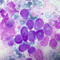 Acute promyelocytic leukaemia with t(15;17) 1