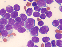 B-ALL marrow aspirate