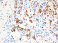 Juvenile Myelomonocytic Leukemia (JMML)