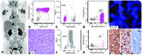 T-cell prolymphocytic leukemia negative for surface CD3 and CD45