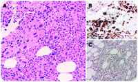Concurrent JAK2 mutation and isolated del(5q) associated with marrow fibrosis and small hypo/monolobated megakaryocytes