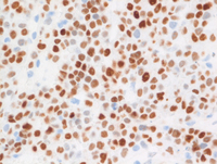 EBV+Plasmablastic lymphoma