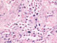 EBV+Plasmablastic lymphoma-EBER