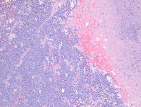 EBV+ plasmablastic lymphoma