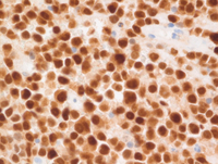 EBVPlasmablastic-lymphomaMUM1