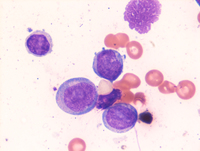 AML-CEBPA-Aspirate