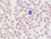 MDS-RS-SLD-Blood