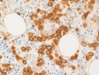 Intravascular DLBCL-BCL2 IHC