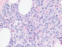 Intravascular DLBCL-Biopsy HE