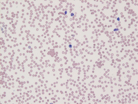 Intravascular DLBCL-Blood
