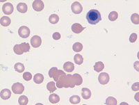 Intravascular DLBCL-Blood