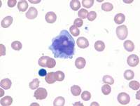 Intravascular DLBCL-Blood