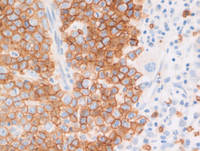 MPN JAK2-PCM1-Glycophorin-C