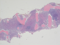 MPN JAK2-PCM1-Biopsy HE