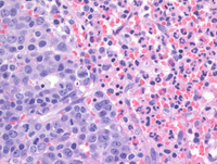 MPN JAK2-PCM1-Biopsy HE