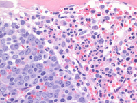 MPN JAK2-PCM1-Biopsy HE