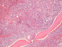 APL-Biopsy
