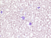 MPN-Polycythemia Vera