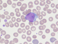 MPN-Polycythemia Vera