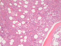 MPNPolycythemia-Vera