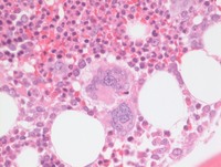 MPNPolycythemia-Vera