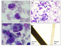 Chediak Higashi syndrome in accelerated phase