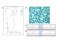 HbH disease with Poly A; AATAAA->AATA- - deletion