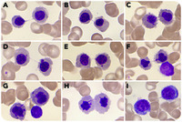 Internuclear bridging outside of primary myelodysplasia and congenital dyserythropoietic anemia