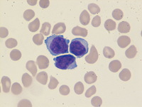 T-Prolymphocytic leukemia