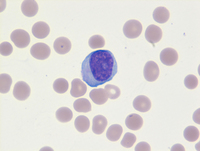 T-Prolymphocytic leukemia