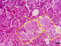 Biopsy sample of a patient with ET 3