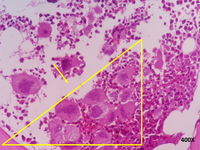 Biopsy sample of a patient with ET 4