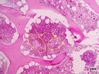 Biopsy sample of a patient with ET 6