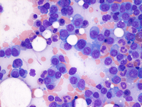 Myeloma