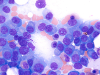 Myeloma