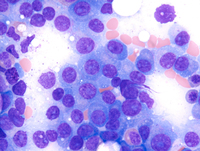 Myeloma